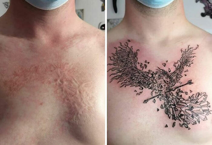 Childhood Burn Turns Into A Phoenix