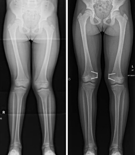 Pre and Post Corrective Surgery