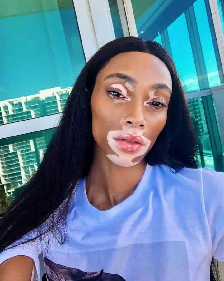 Winnie Harlow