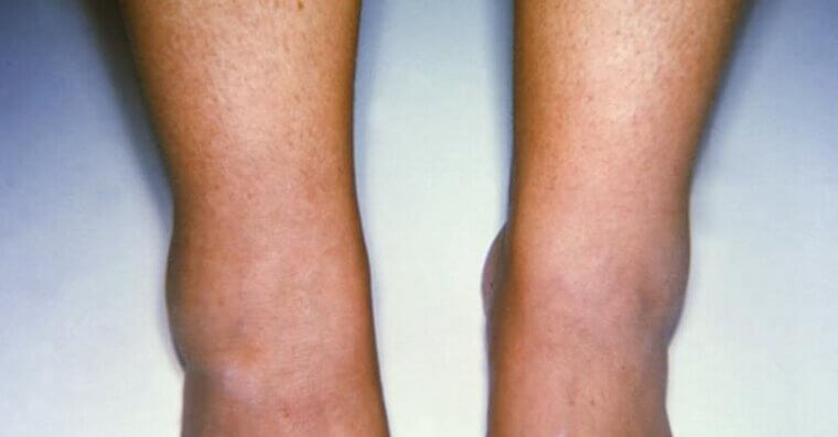 Swelling in Legs or Ankles