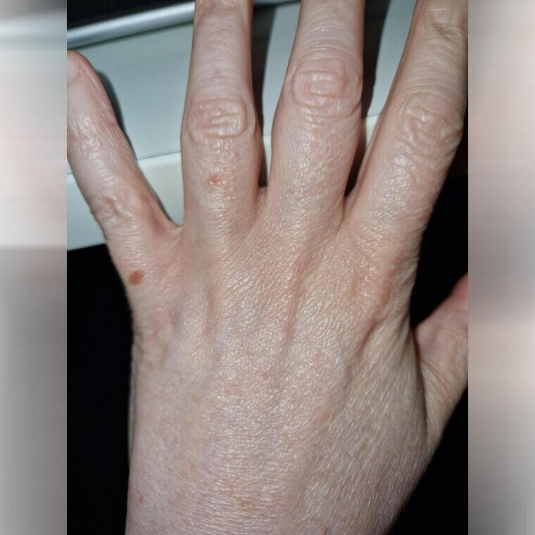 Dull Nails and Hands