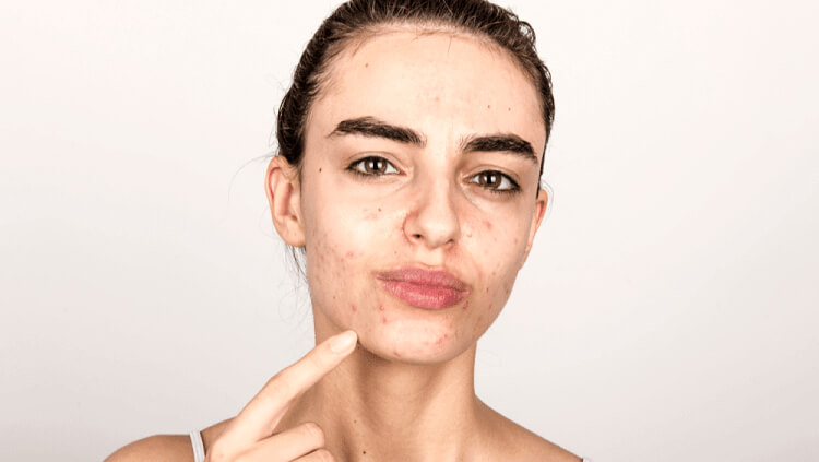 Tips To Soothe Acne Breakout