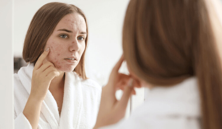 What Else Causes An Acne Breakout?