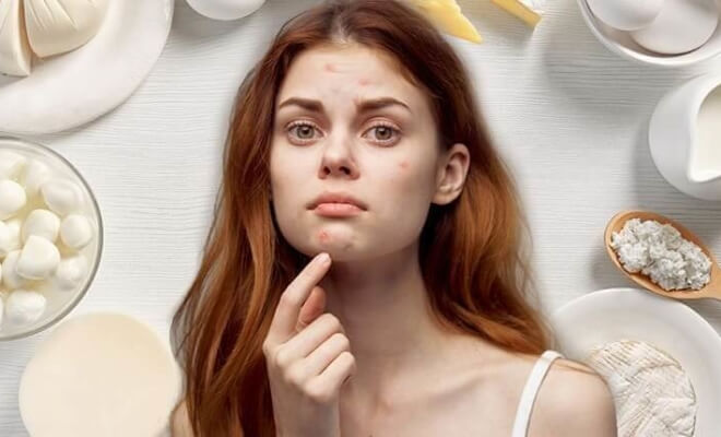 Does Dairy Cause Acne?