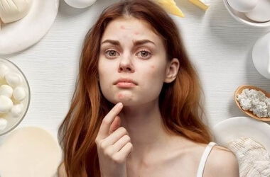 Does Dairy Cause Acne?