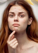 Does Dairy Cause Acne?