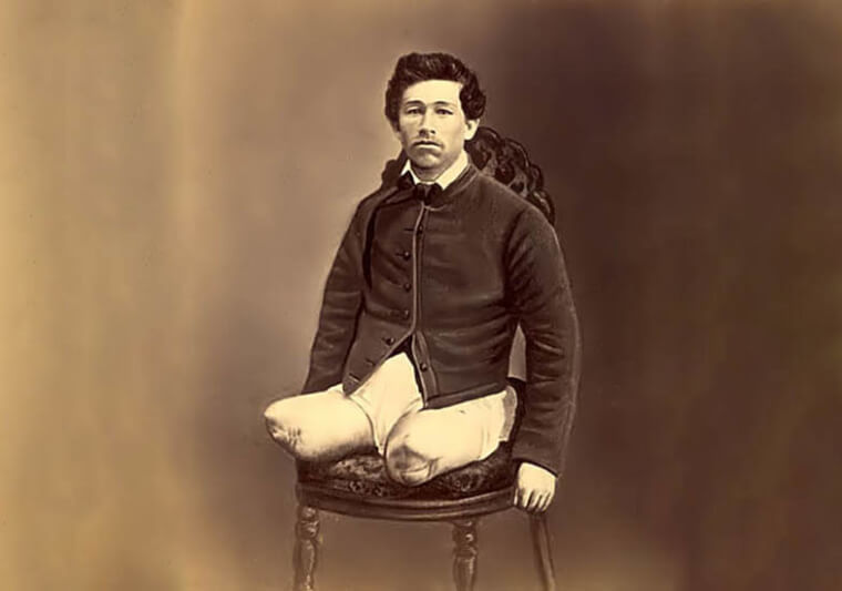 Time Before The Use of Anesthesia In The Battlefield