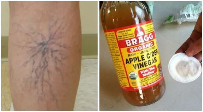 Home Solutions to Help With the Appearance of Spider Veins