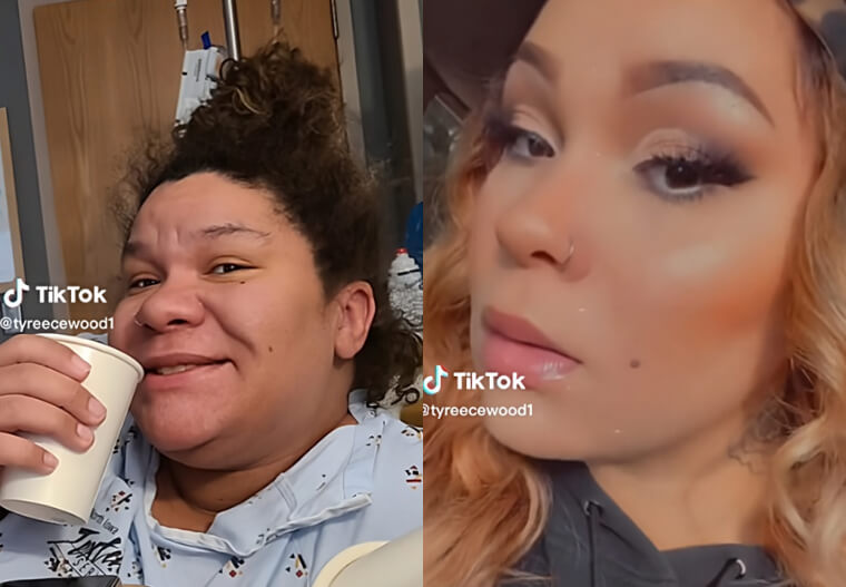 Pregnancy Can Reshape Your Face