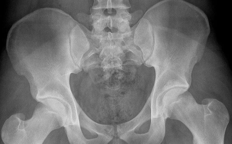 A Female Pelvis Is Wider Than a Male Pelvis to Handle Childbirth