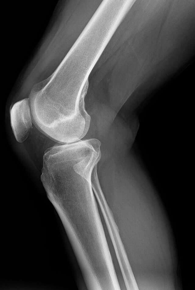 Women's Bones Are Much Lighter Than Men's Bones