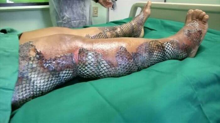 Fish Skin Can Be Used For Human Skin Grafts