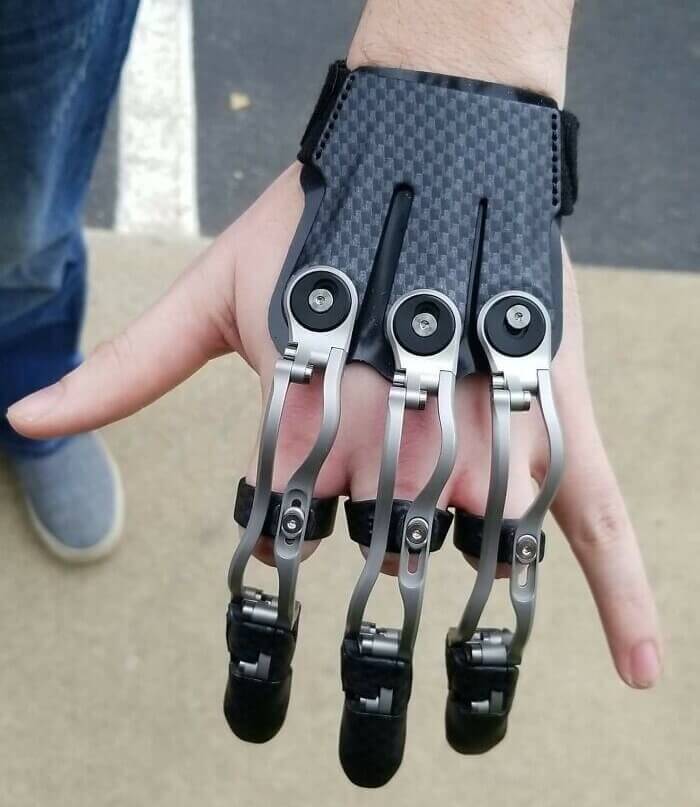 This Man Got His First Prosthetic Hand
