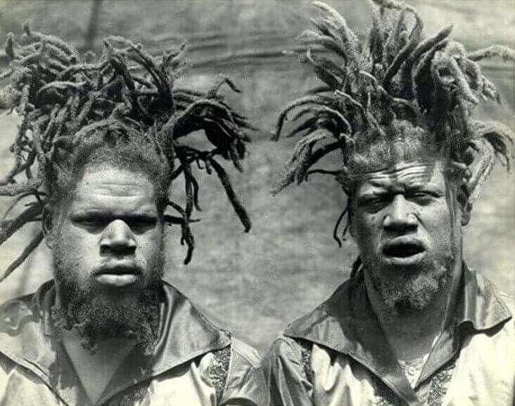 Identical Albino Twins Were Kidnapped