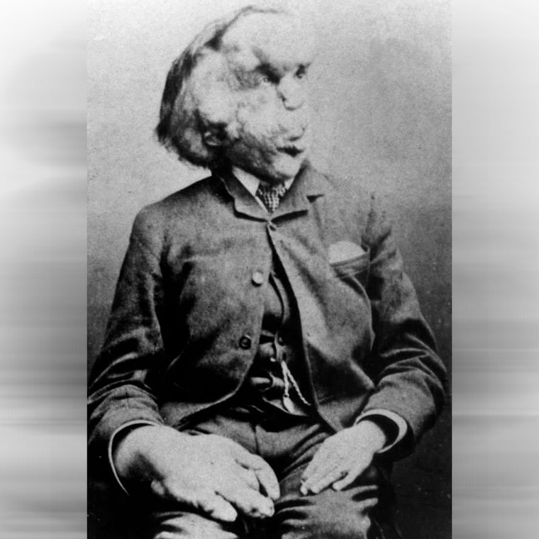 Joseph Merrick: The Elephant Man