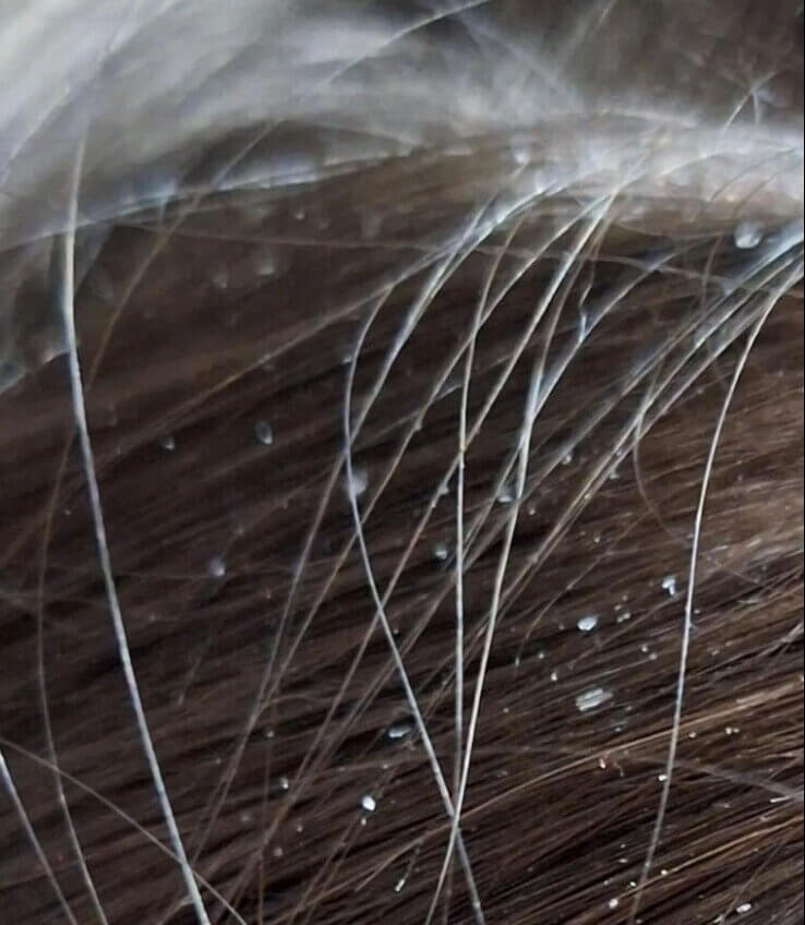 No More Lice Problem