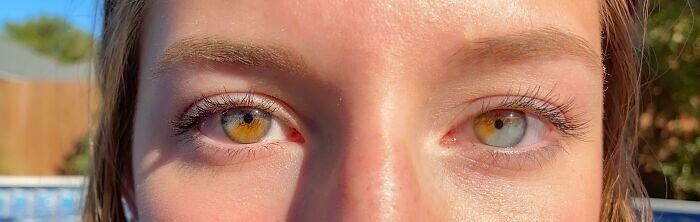 Partielle Heterochromie in beiden Augen