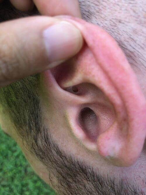 An Ear With An Extra Hole