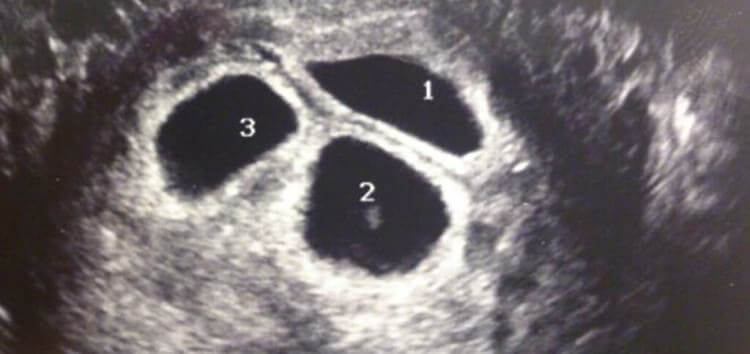 Not One, Two, But Three Babies