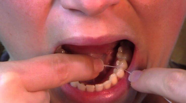 Not Flossing Daily Is Worse for You Than You Realize