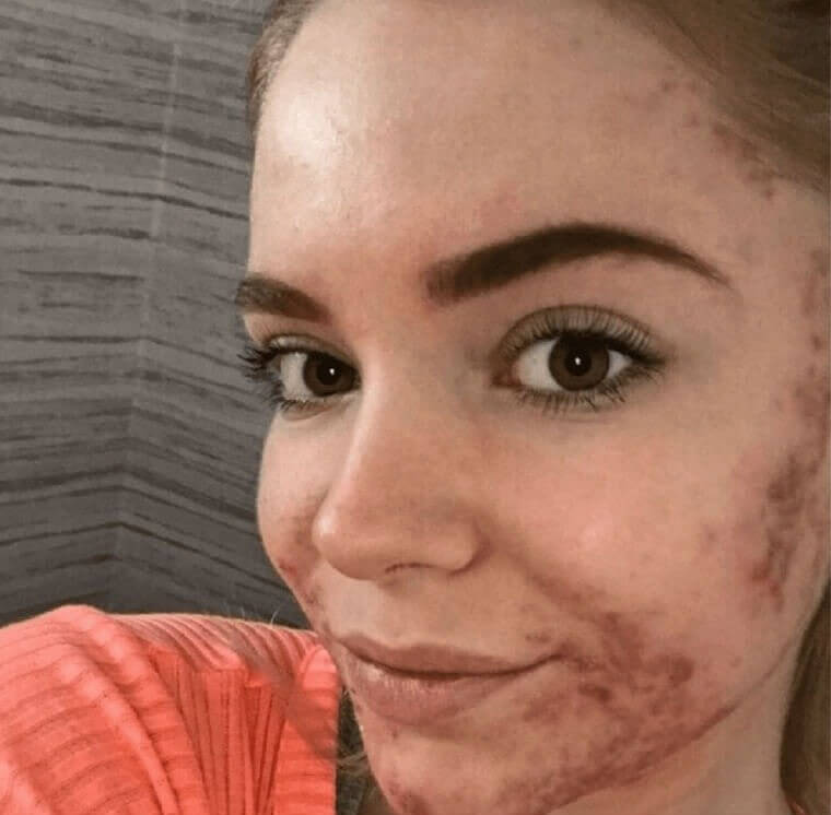 Avoid Popping Your Pimples at All Costs