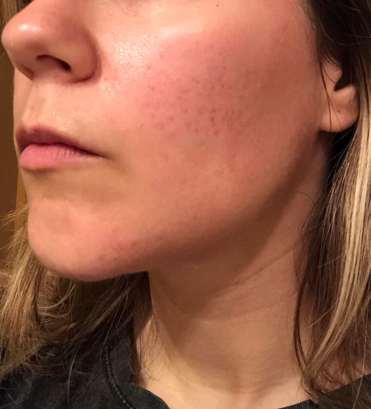 Don't Rely on Makeup Wipes to Clean Your Face