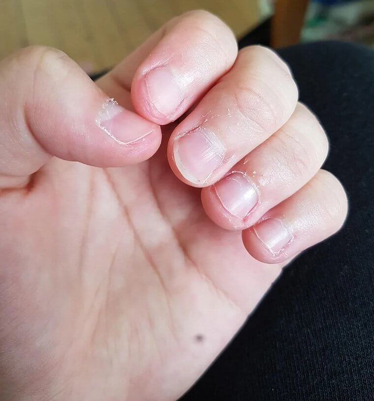 Nail Biting May Seem Harmless but the Reality Is Serious