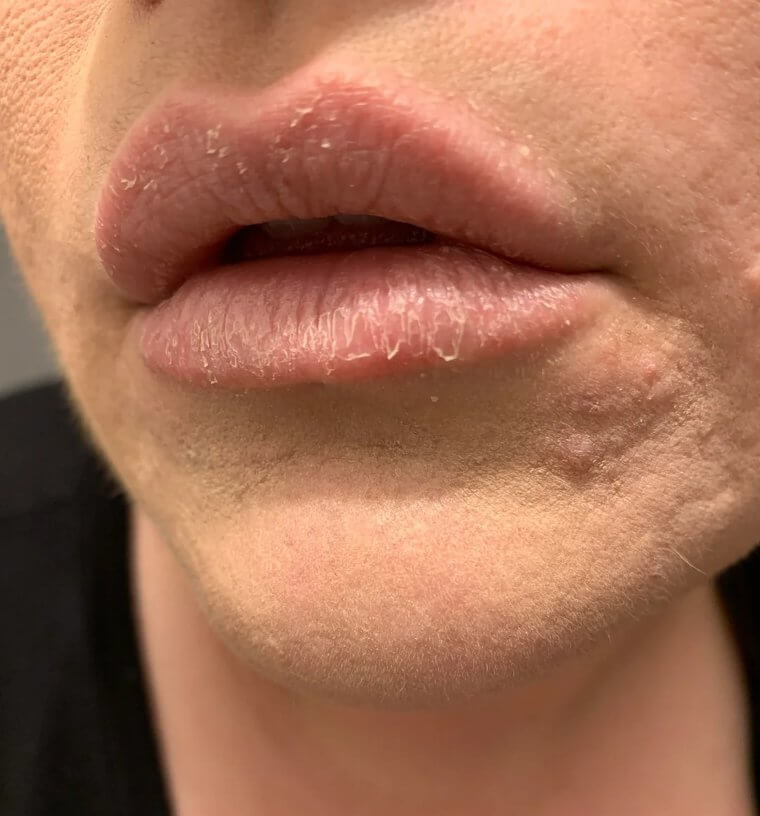 Picking the Skin off Chapped Lips Will Only Make Them More Irritated