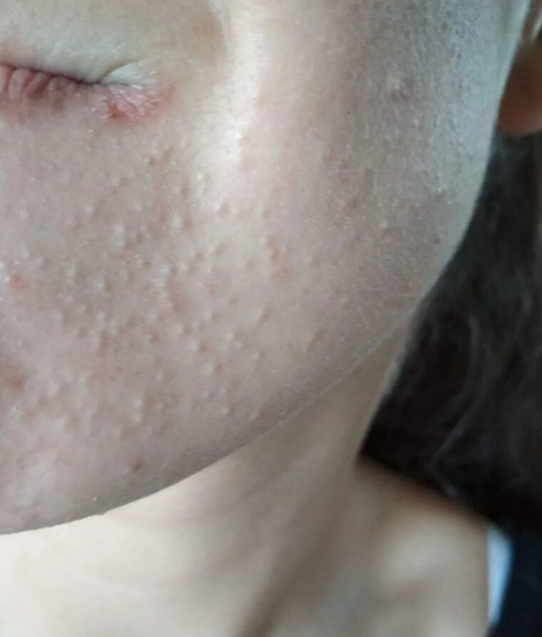 Threading Your Mustache and Chin Can Cause Irritation