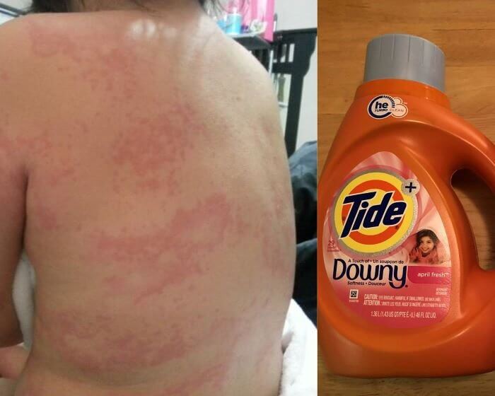 You Got a Mysterious Rash? Be Careful With These Products