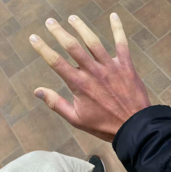 Žlté prsty z Raynaudovej choroby