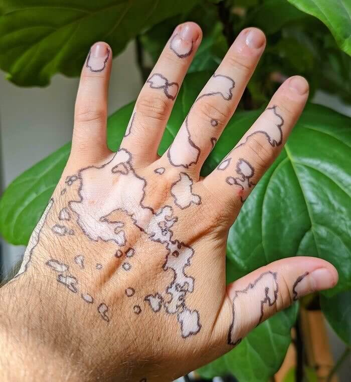 Mapa okolo škvŕn Vitiligo