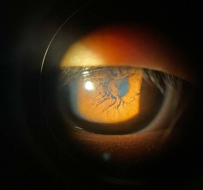 Membrana pupilar persistente en el iris del ojo