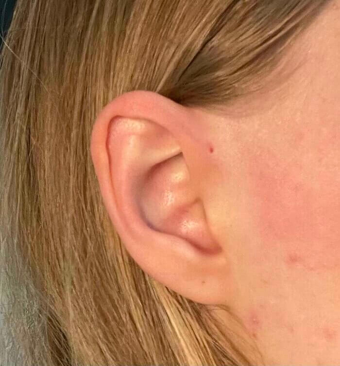 El conducto lagrimal adicional en la oreja