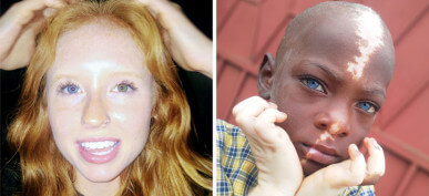 30+ People With Rare Genetics That Make Them Unique