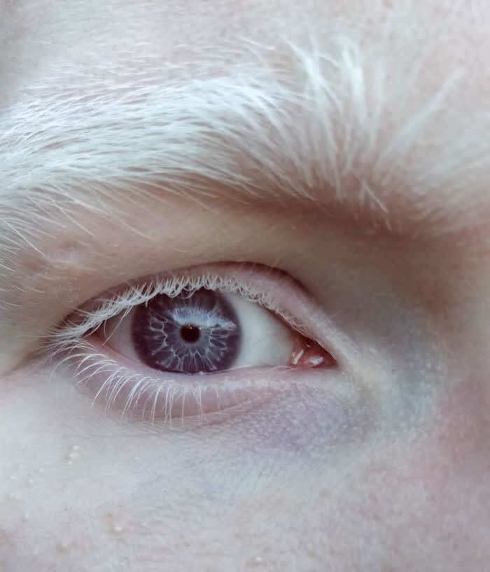Албинизъм, причиняващ светкавични очи