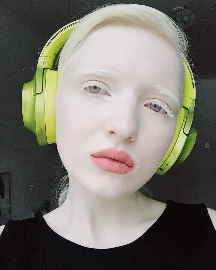 Бяла коса, мигли и бледа кожа поради албинизъм