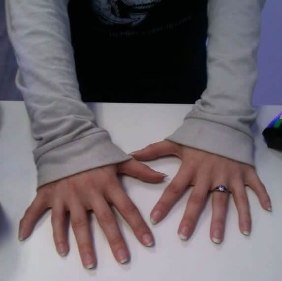 Ръце с шест пръста
