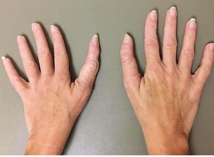 Палец с три фаланги