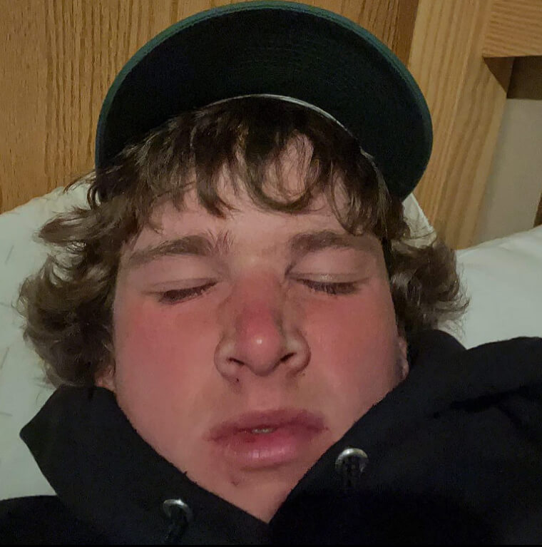 Fermate Gli Starnuti Premendo Il Labbro Superiore