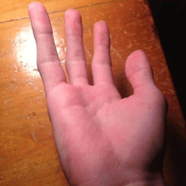 小指がない人には突然変異がある