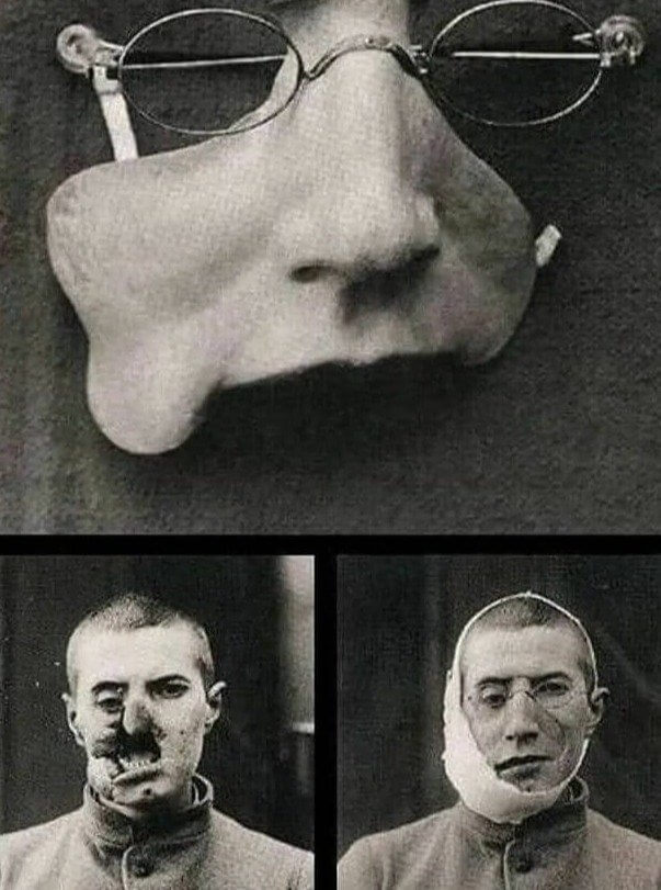 Facial Prosthesis For A Wounded Soldier in 1916