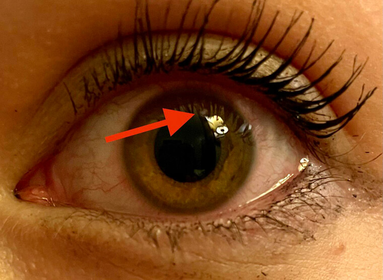 Manchas amarelas e brancas nos olhos podem ser causadas por muito sol
