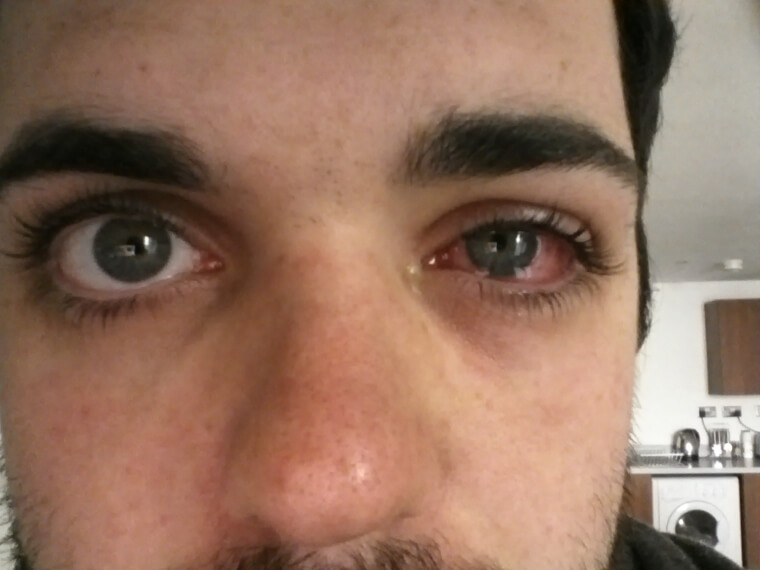 Infecções oculares podem se tornar graves rapidamente
