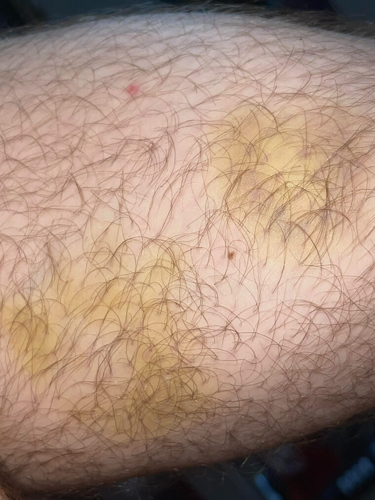 Manchas amarelas e marrons podem ser causadas por necrobiose lipoídica