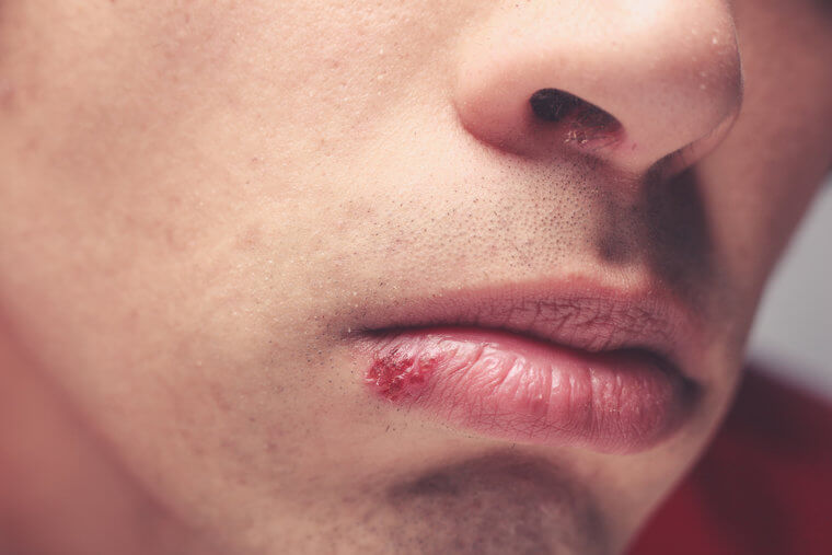 Aftas podem ser herpes