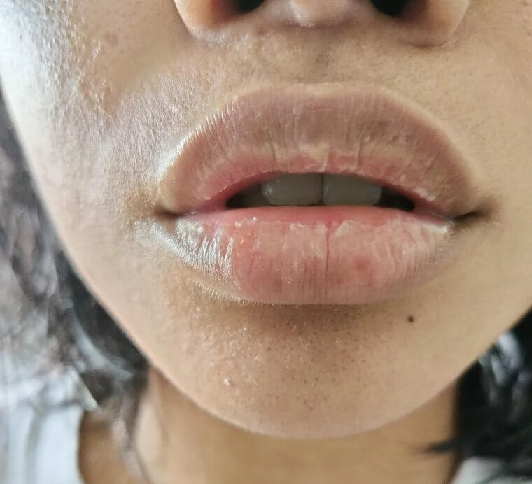 Lábios extremamente rachados podem indicar uma deficiência de vitamina