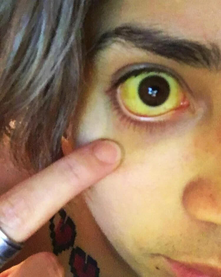 A icterícia pode causar olhos amarelos