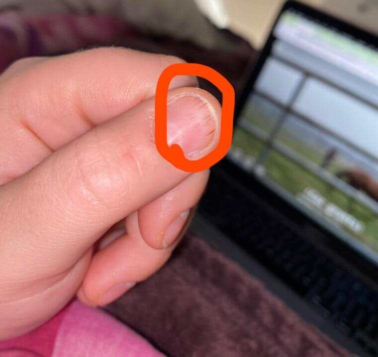 Linhas sob as unhas podem indicar doença cardíaca