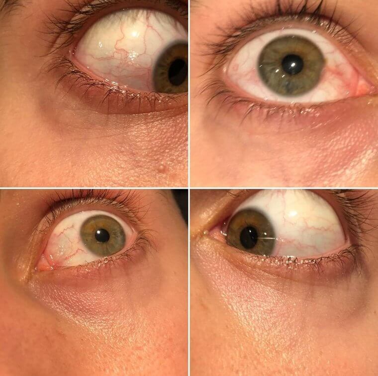 Olhos danificados às vezes são causados por pressão alta